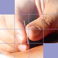 Acupuncture