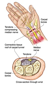 Carpal Tunnel Syndrome